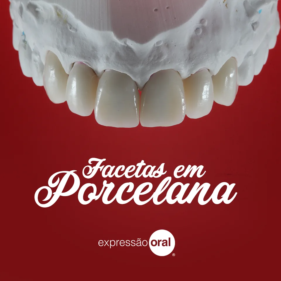 Peça sobre facetas em porcelana — Expressão Oral